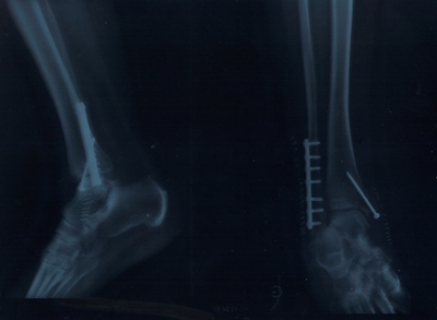 A broken ankle and fantastic care in French Health System